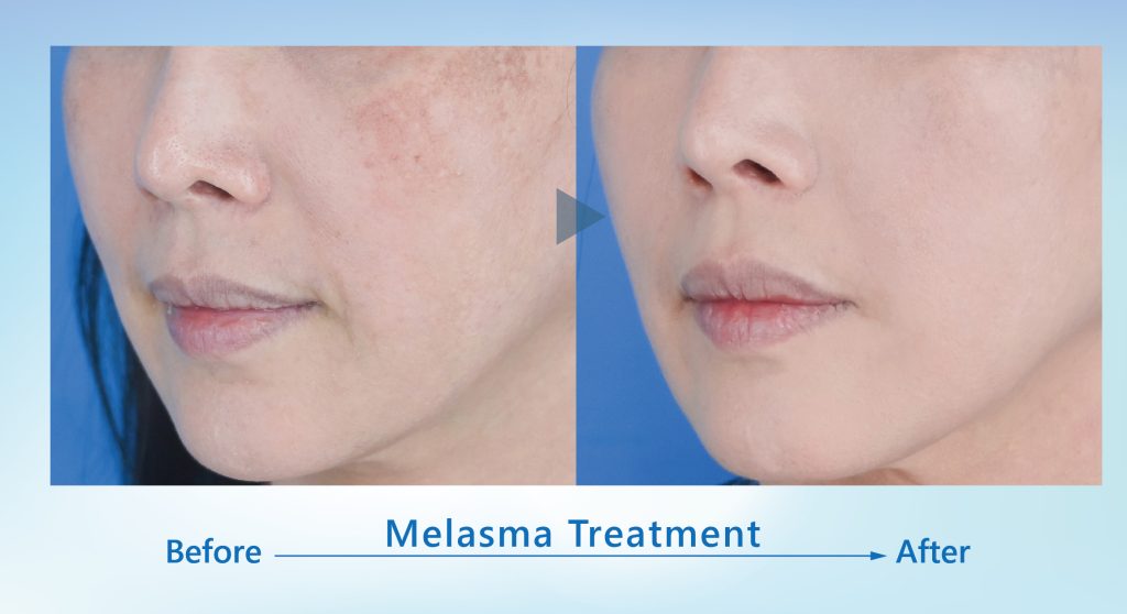 Water Glow Injection/Manual Water Glow Injection-improving skin quality ...