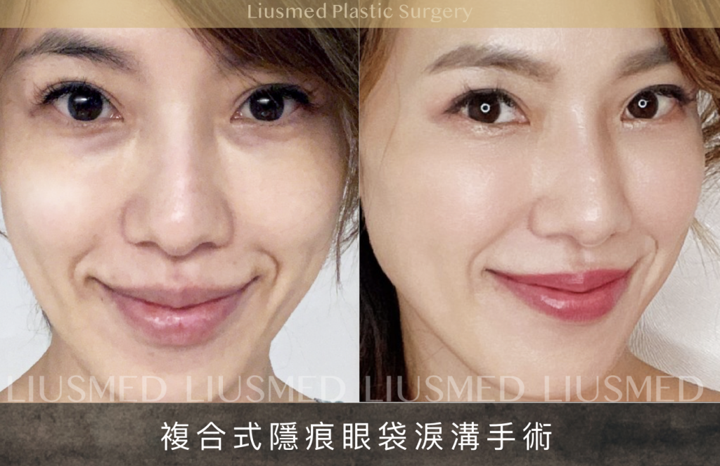黃瑄眼袋淚溝_02