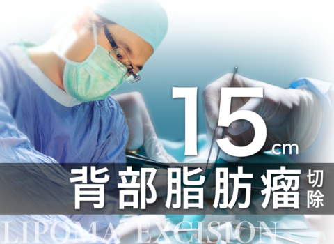 背部巨大脂肪瘤切除