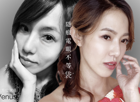 隱痕眼袋淚溝術